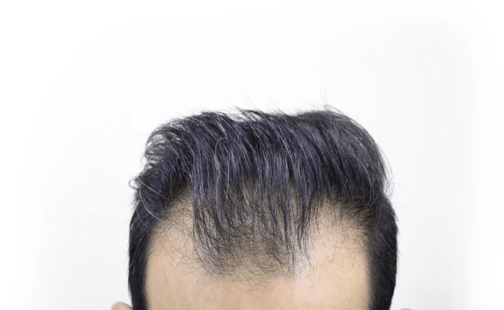 Before